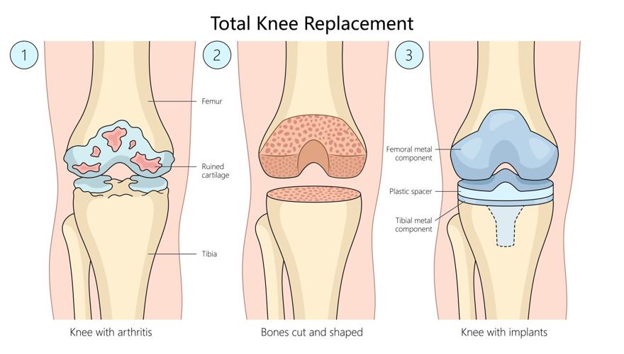 Total knee replacement