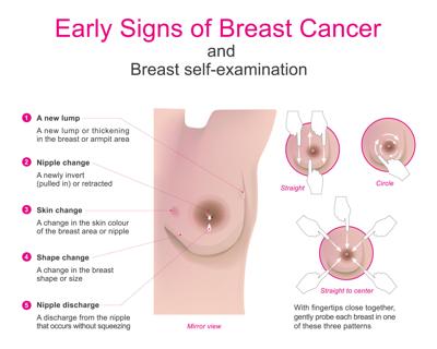 Breast Cancer Signs and Symptoms